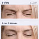 ELYVIA Skin Renewal Patches™