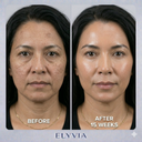 ELYVIA Skin Renewal Mask™